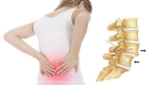 Thoát vị đĩa đệm